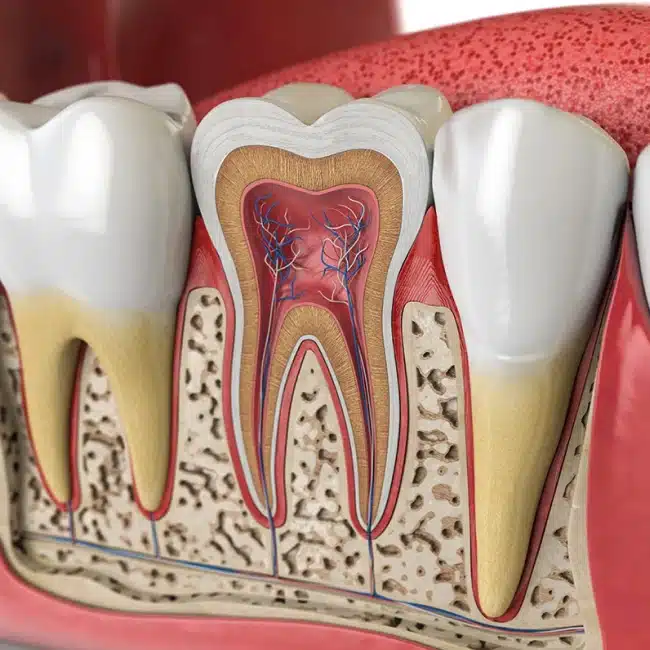 Root canal therapy at Boutique Smiles Plantation FL