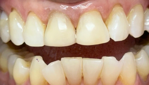 Cosmetic dentistry after treatment results