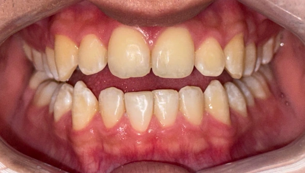 Dental treatment after procedure results