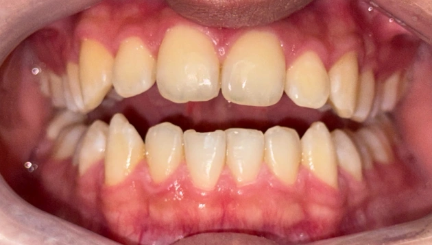 Dental treatment before procedure results