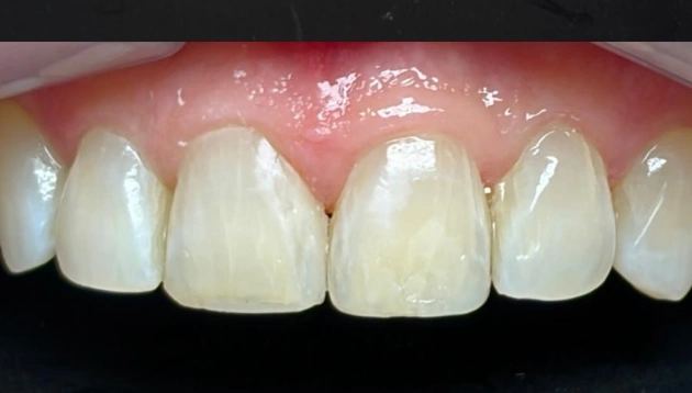 Teeth restoration after treatment results