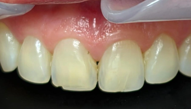 Teeth restoration before treatment results