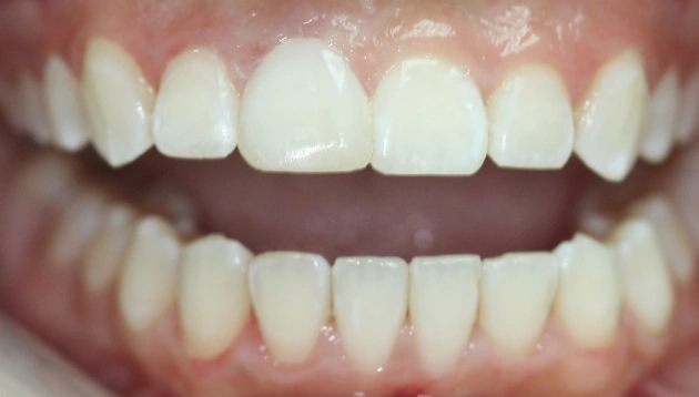 Teeth whitening after treatment results