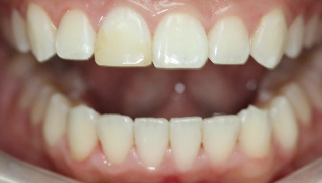 Teeth whitening before treatment results