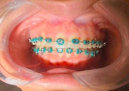 Interceptive care braces on child's teeth