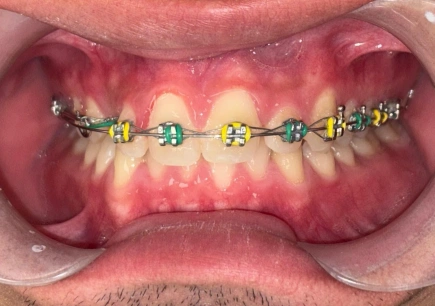 Colored braces on teeth