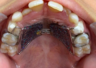 Dental appliance fitted behind the front teeth