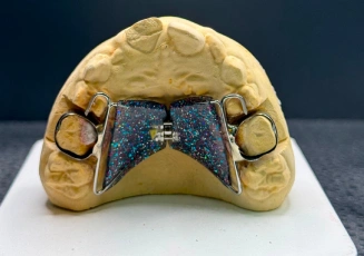 Orthodontic appliance on a dental model