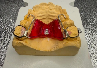 Red dental appliance on upper teeth