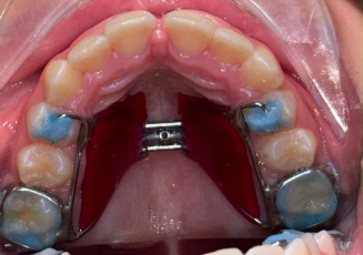 Dental appliance being fitted inside the mouth