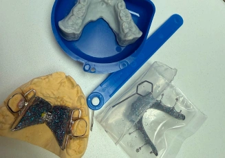 Blue dental appliance on a dental model