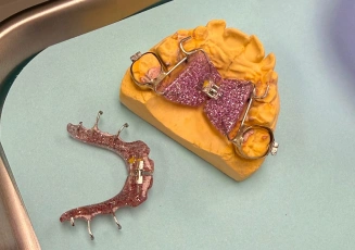 Red dental appliance on a dental model