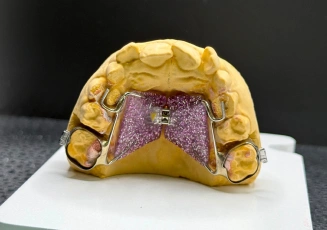 Retainer appliance on a dental model