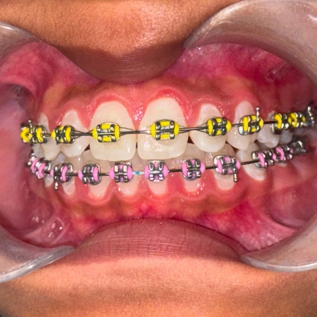 Braces on teeth