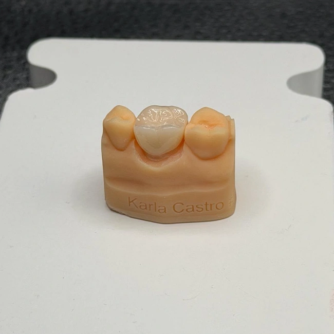 Dental crown on a dental model
