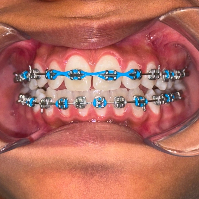 Braces on teeth