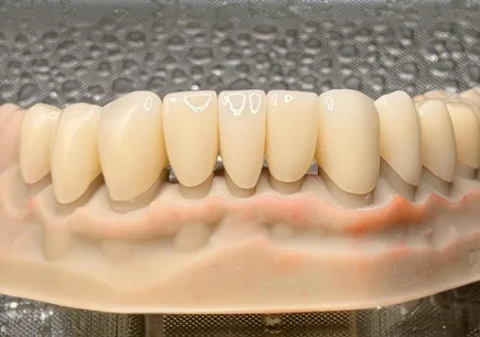 Zirconia Crowns