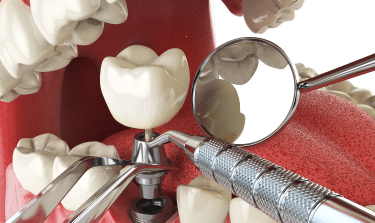 Dental Implants Are Effective, But Are They Safe? What The Latest Research Says