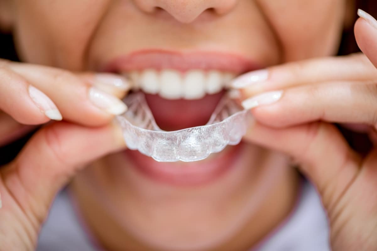 How Invisalign Treatment Works: An Easy Step By Step Explanation