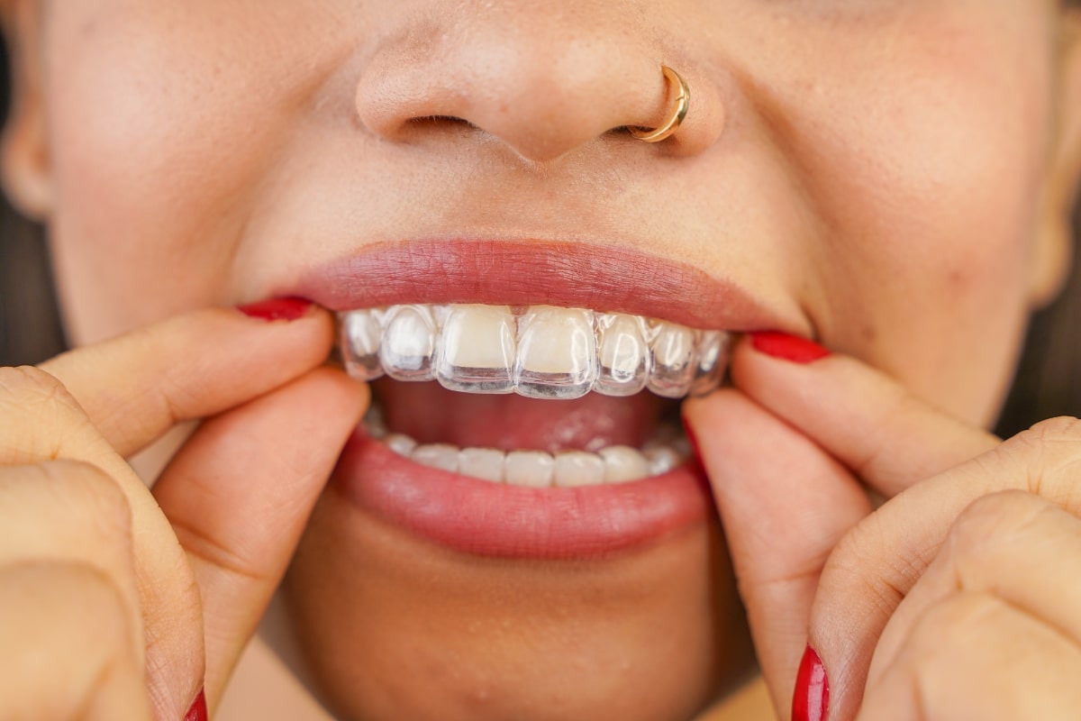 How Does Invisalign At Town Square Dentistry Improve Oral Hygiene