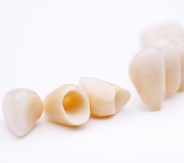 Boynton Beach Dental Crowns and Dental Bridges