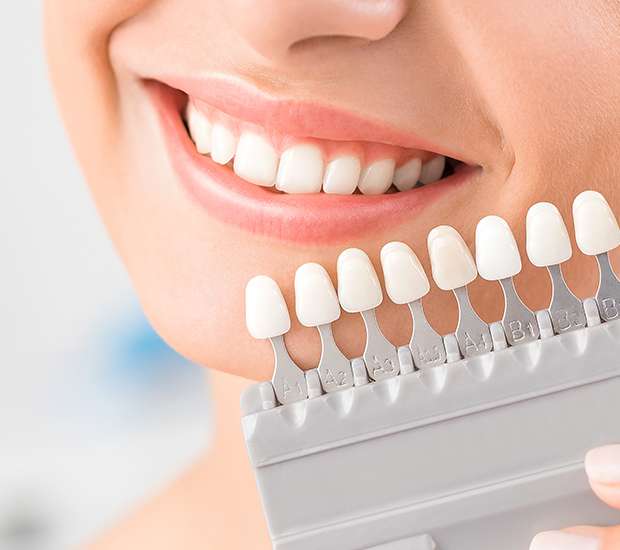 Boynton Beach Dental Veneers and Dental Laminates