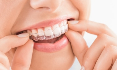 Top Tips To Keep Your Invisalign Aligners Clear And Stain Free
