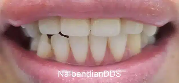Close-up of patient's smile showing straight, white teeth after dental treatment in Burbank.