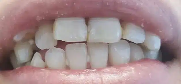 Before dental treatment showing misaligned and crowded upper front teeth.