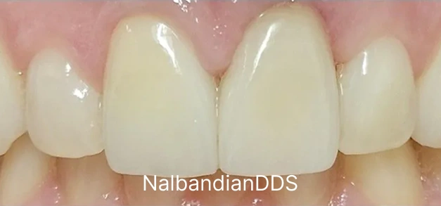 After cosmetic dental treatment, patient displays bright white front teeth with natural contours.
