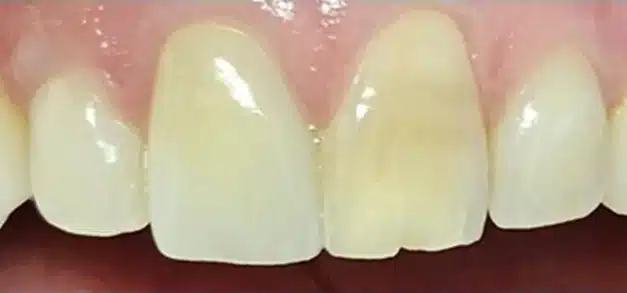 Before dental treatment showing discolored upper front teeth with uneven shading and surface staining.