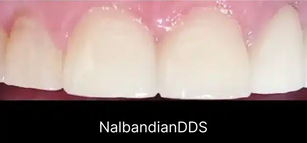 After teeth whitening treatment showing bright white front teeth with healthy pink gums.