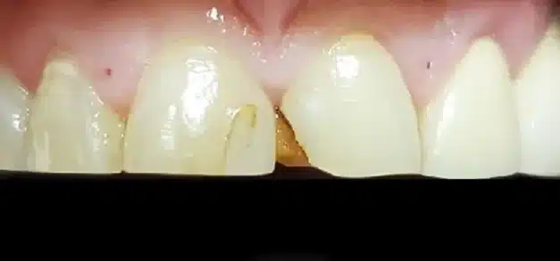 Before and after dental restoration showing tooth gap closure and whitening results.