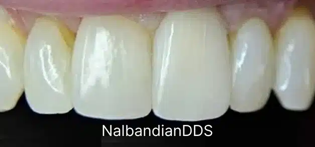 After treatment smile showing six bright white front teeth with excellent cosmetic results.