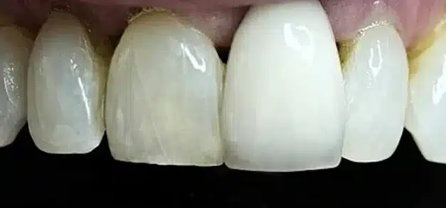 Before dental treatment: discolored and uneven front teeth requiring cosmetic restoration.