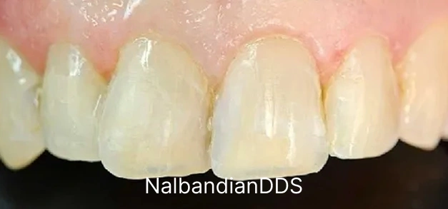 After smile makeover showing bright, natural-looking front teeth with improved alignment and whiteness.