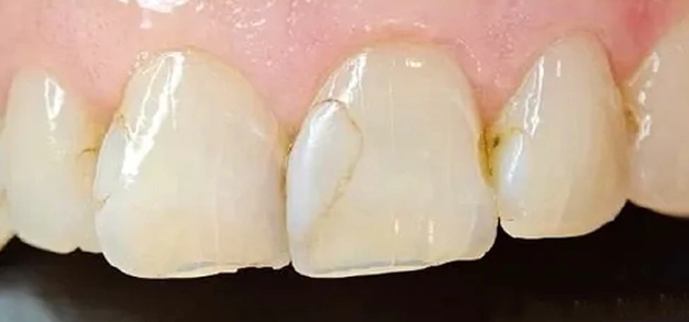 Before photo showing front teeth with discoloration and uneven appearance.