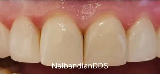 After dental treatment showing four natural-looking front teeth with improved appearance and brightness.