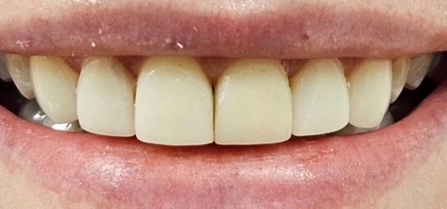 Before dental treatment showing upper front teeth with discoloration and uneven appearance.