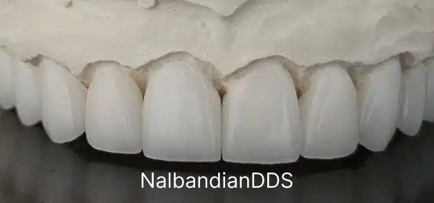 After dental treatment showing six upper front teeth with a bright white smile in Burbank.