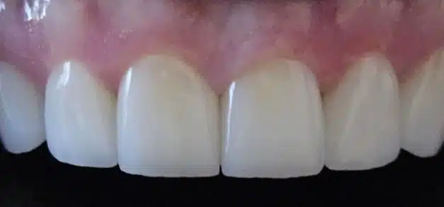 Before dental treatment showing discolored and uneven front teeth needing restoration.