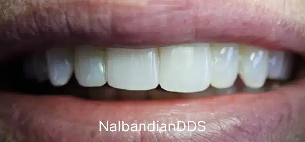 After smile makeover showing six restored front teeth with natural appearance and proper alignment.