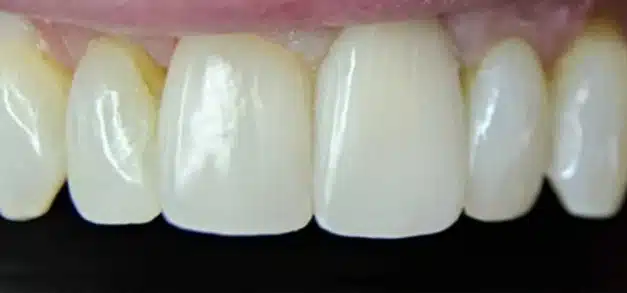 Before smile makeover showing discolored and uneven front teeth needing cosmetic dental treatment.
