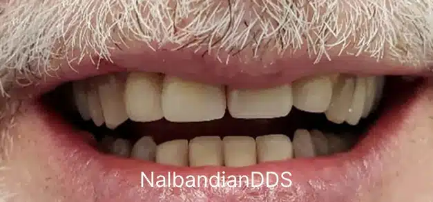 Close-up of patient's smile after cosmetic dental treatment in Burbank.