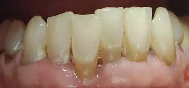 Before photo showing patient's upper teeth with discoloration and uneven wear.