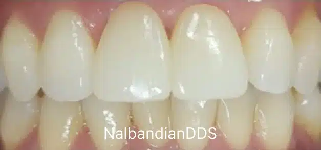Before and after dental whitening results showing brightened front teeth in Burbank.