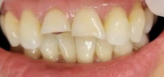 Before dental treatment showing crowded upper front teeth with misalignment.