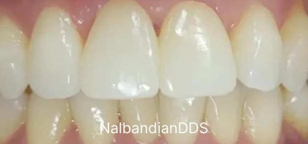 Dental crowns after in Burbank Dentist