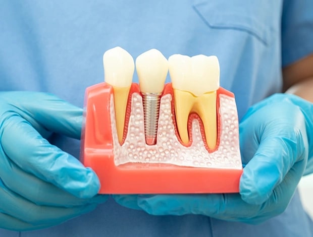 Dental Implants in Burbank dentist