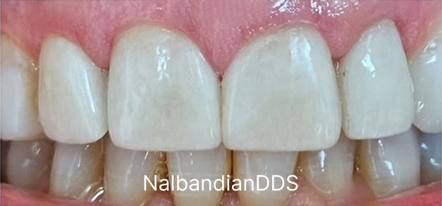 Dental veneers after in Burbank Dentist